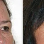 614a50c1fdd0a10dc71d1d63 Brow Lift Results - 01