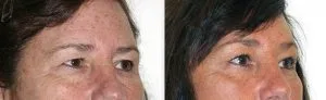 614a50c1fdd0a10dc71d1d63 Brow Lift Results - 01