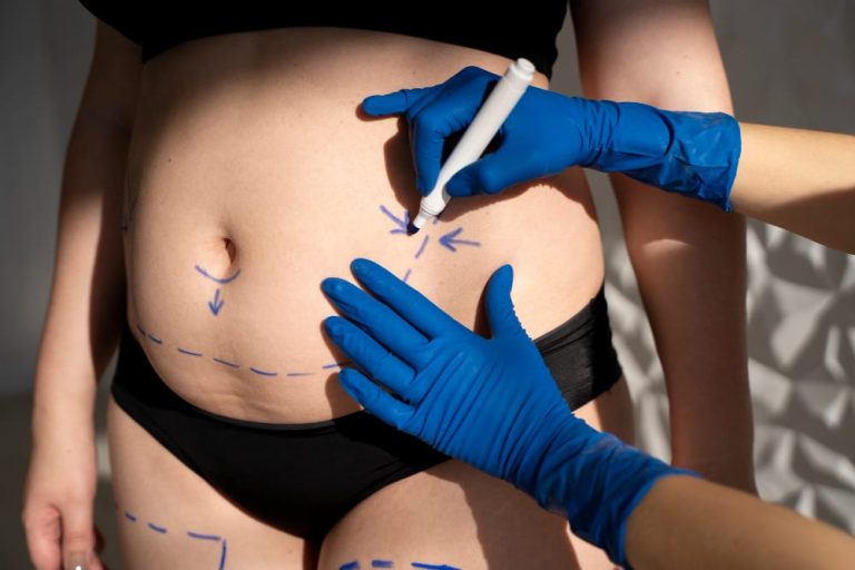 Tummy Tuck Surgery: Everything You Need to Know Before the Procedure – Recovery Time, Scars, and Before & After Results