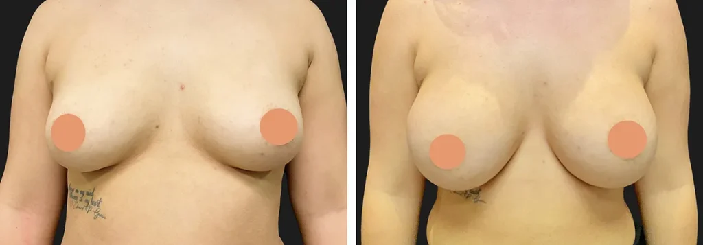 AP-breast-augmentation-after-01