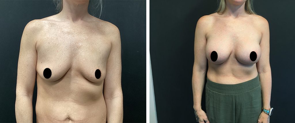 Breast Augmentation Before and After Photos
