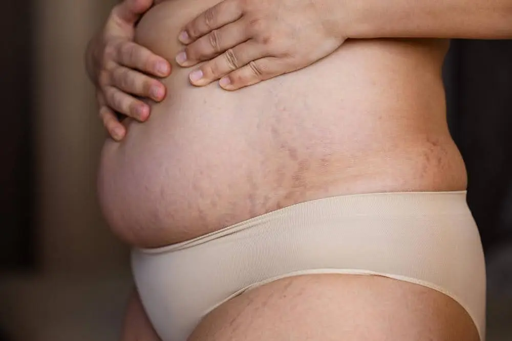 Can a Tummy Tuck Fix Stretch Marks and Loose Skin?