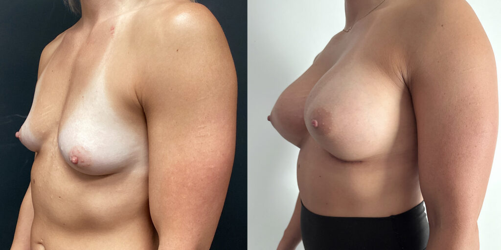 Dual-Plane-Breat-Augmentation-Before-after-case-02