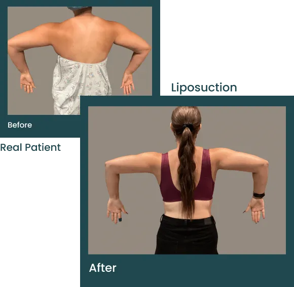 Liposuction in Kirkland & Bellevue