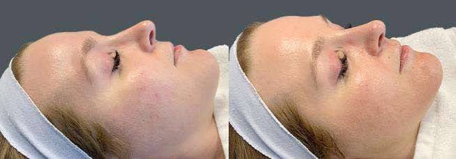Microneedling with Rejuran Before and After
