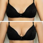 What Should Patients Expect During a Breast Augmentation Consultation