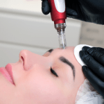 Who Does the Best MicroneedlingWho Does the Best Microneedling in Bellevue and Kirkland