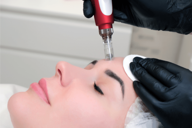 Who Does the Best MicroneedlingWho Does the Best Microneedling in Bellevue and Kirkland