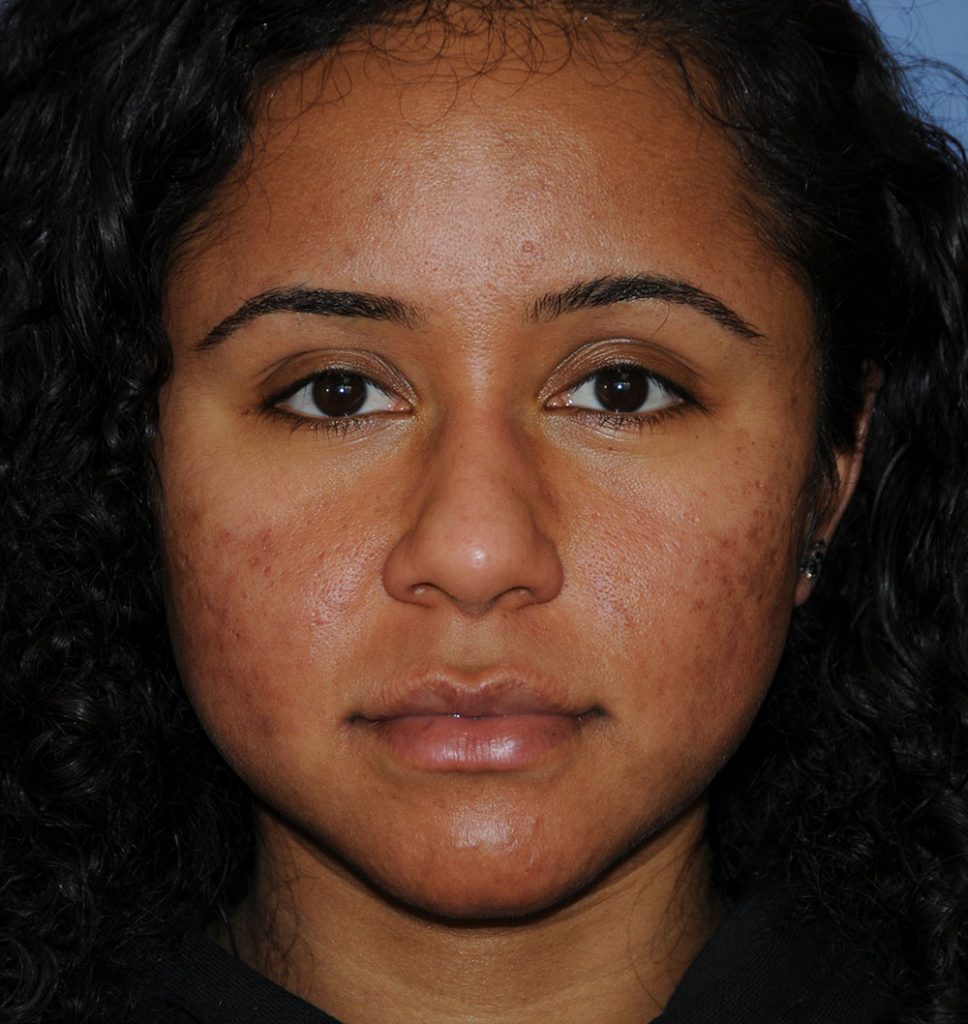 Acne Scarring with Dr. Young in Bellevue & Kirkland Scar Removal