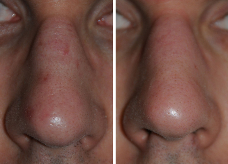 Before and After