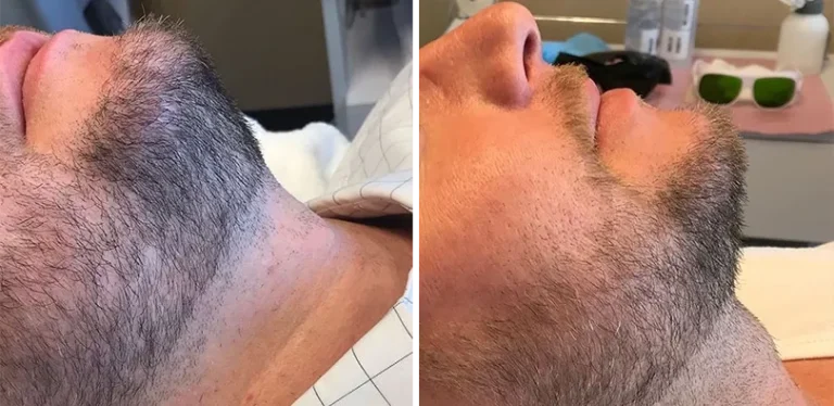 before and after-2 (1)