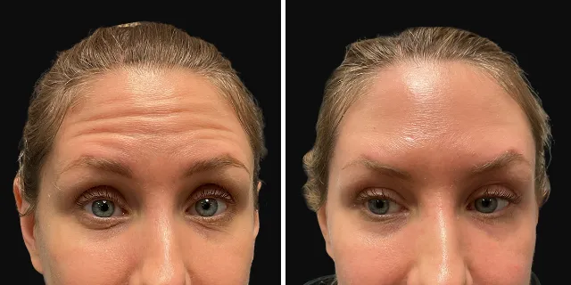 Before & After BOTOX Injections 01