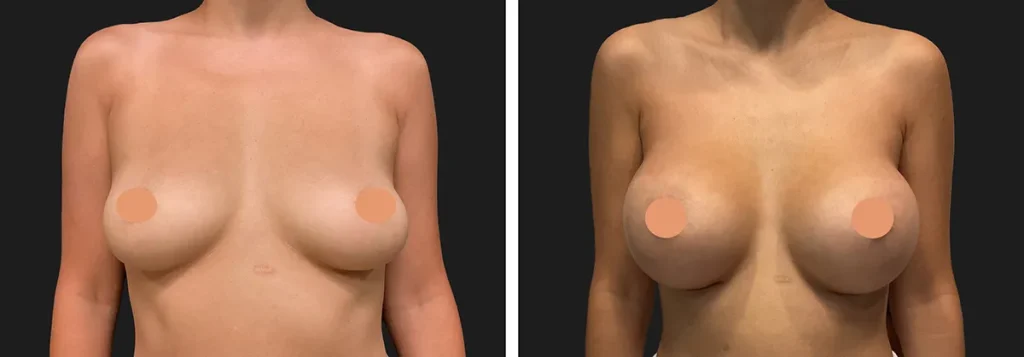 breast-augmentation-02