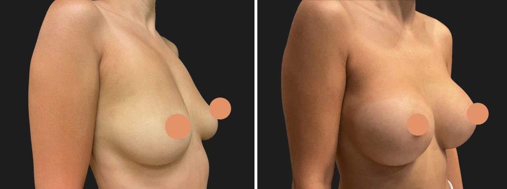 breast-augmentation-kirkland-nwf-before-after-02