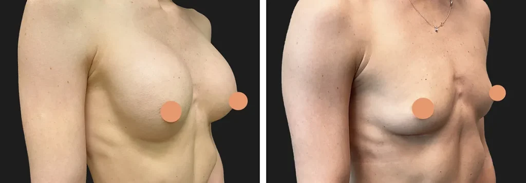 breast-implant-removal-01 (1)