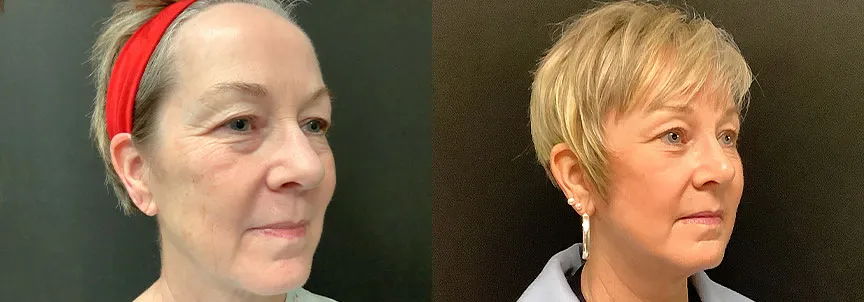 co2-laser-resurfacing-case02