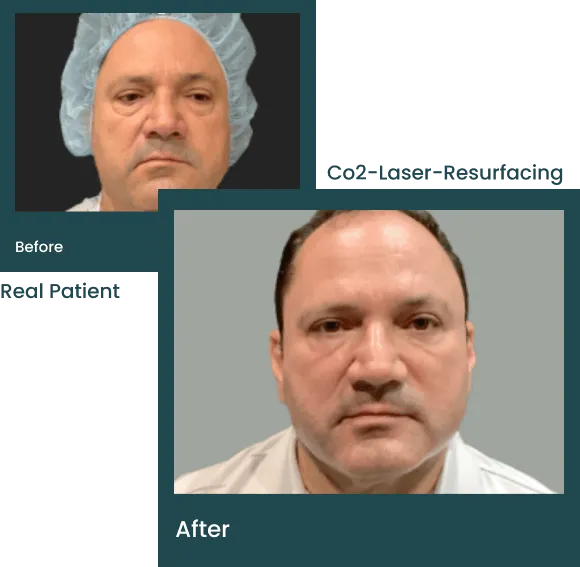 co2-laser-resurfacing