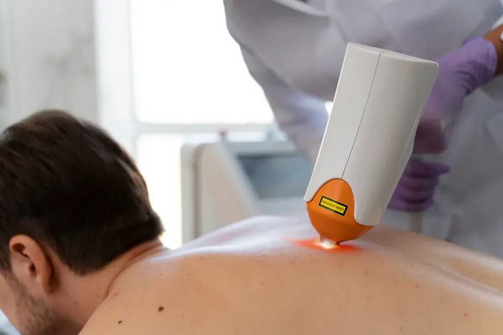Men's Back and Shoulder Laser Hair Removal