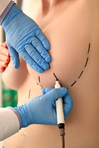 What Is AlloClae® Breast Augmentation?