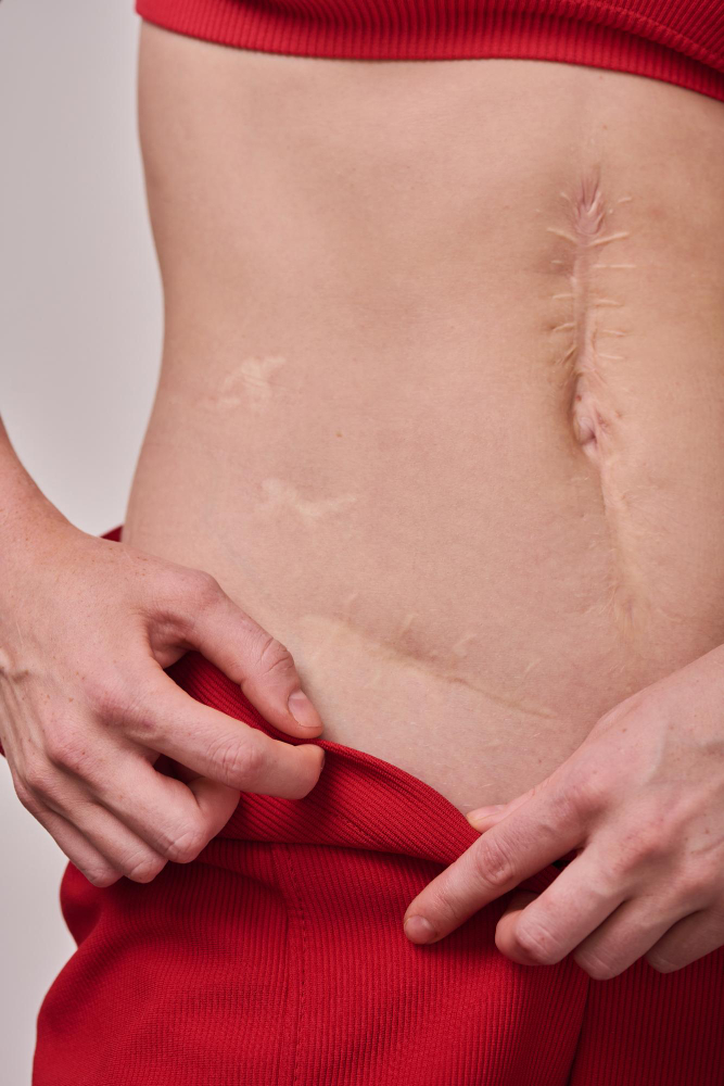 Is Laser Scar Resurfacing In Bellevue & Kirkland Right For You?