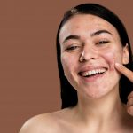 Laser Scar Resurfacing In Bellevue & Kirkland