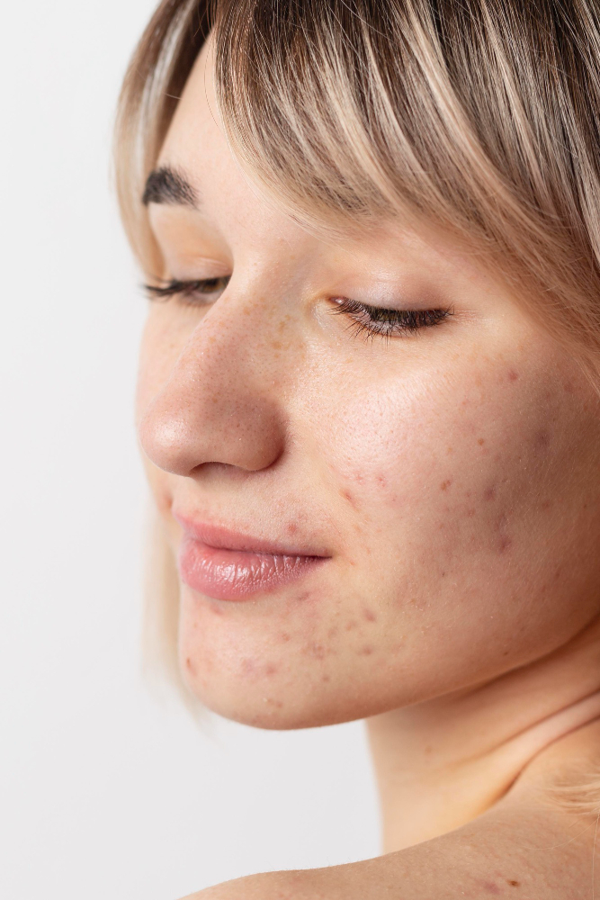 How Does Laser Scar Resurfacing Work?