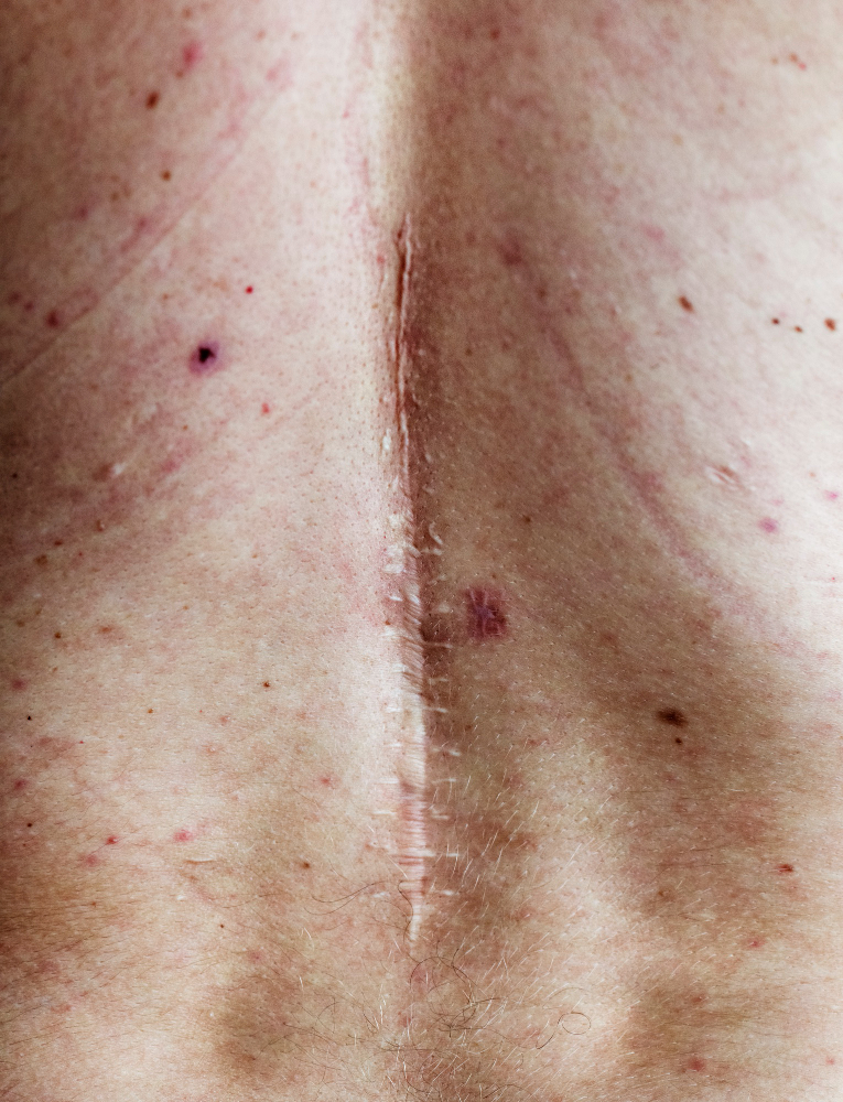 What Types Of Scarring Can Laser Resurfacing Treat?