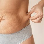Tummy Tuck in Bellevue