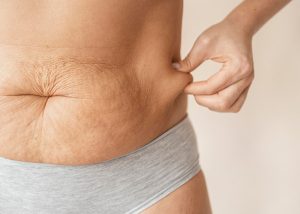 Tummy Tuck in Bellevue