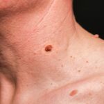 mole removal