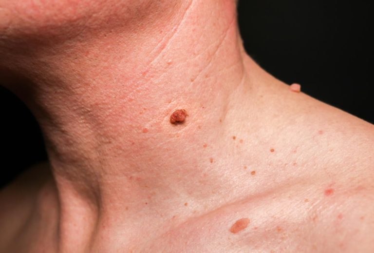 mole removal