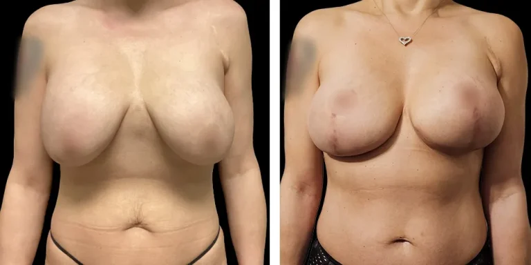 nwf-breast-implant-replacement-before-after-01