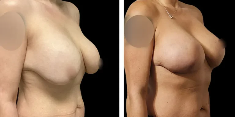 nwf-breast-implant-replacement-before-after-02 1