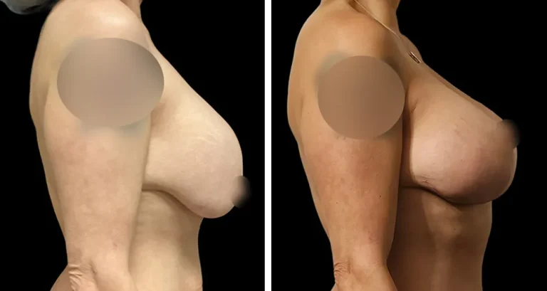 nwf-breast-implant-replacement-before-after-03