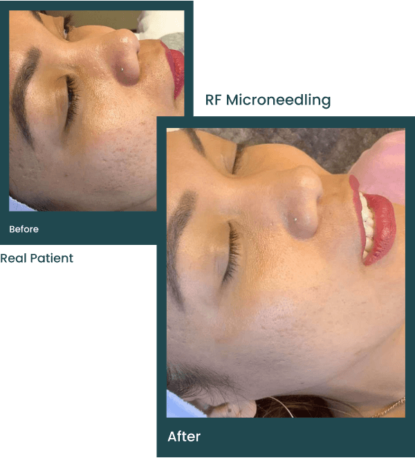rf microneedling